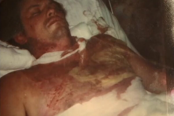 arc flash burn victum laying down