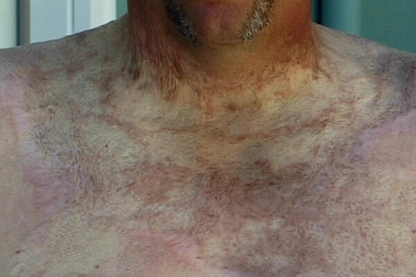 arc flash burn victum
